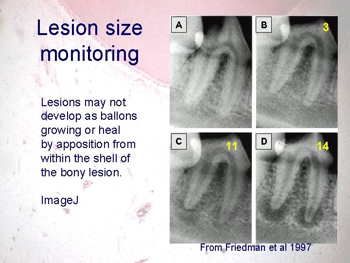 Lesion size monitoring Lesions may not develop as ballons growing or heal by apposition