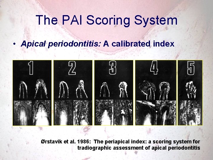 The PAI Scoring System • Apical periodontitis: A calibrated index Ørstavik et al. 1986: