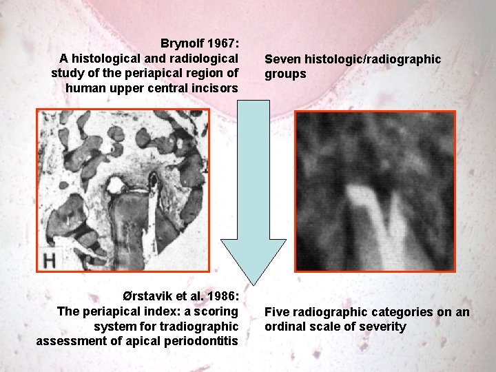 Brynolf 1967: A histological and radiological study of the periapical region of human upper