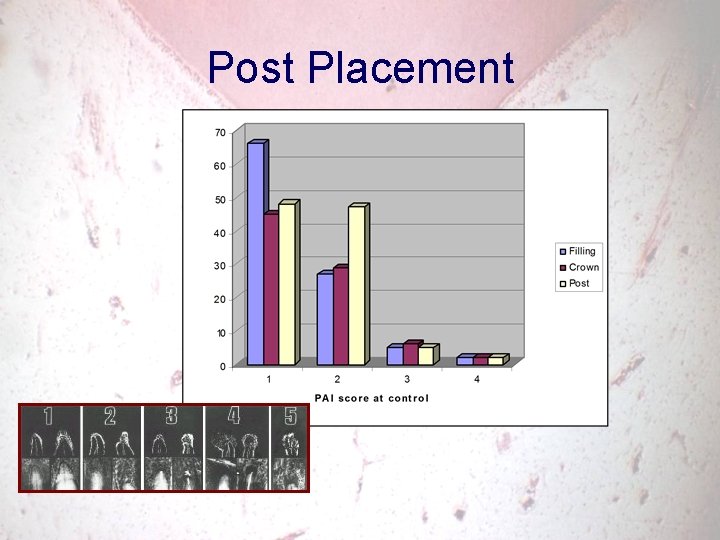 Post Placement 