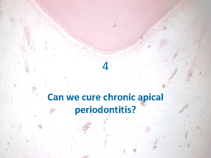 4 Can we cure chronic apical periodontitis? 
