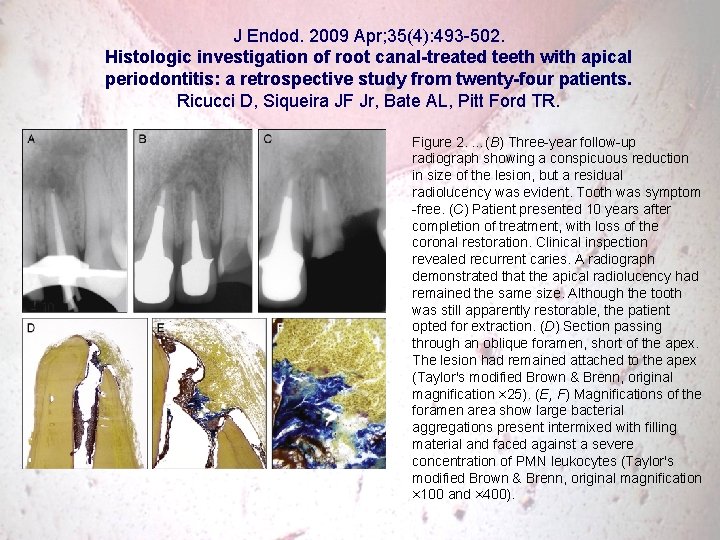 J Endod. 2009 Apr; 35(4): 493 -502. Histologic investigation of root canal-treated teeth with