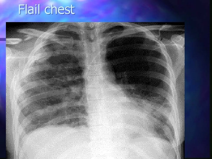 Flail chest 