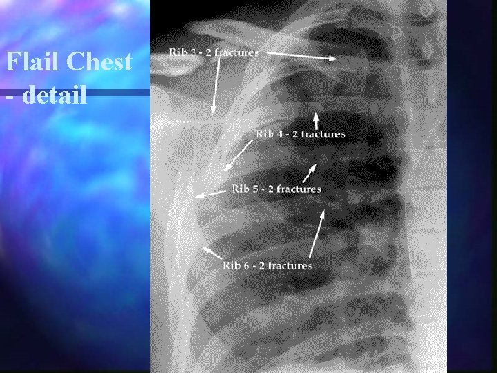 Flail Chest - detail 