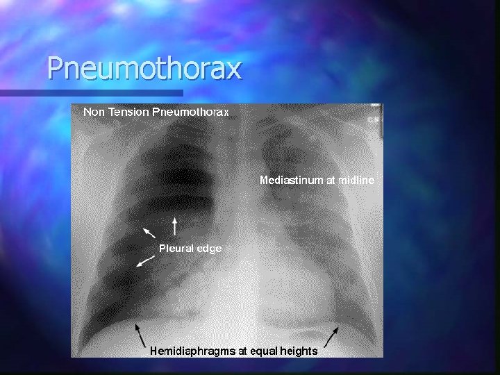 Pneumothorax 