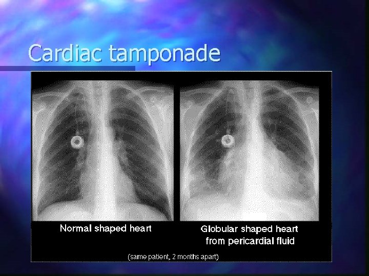 Cardiac tamponade 