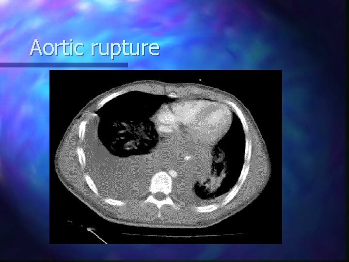 Aortic rupture 