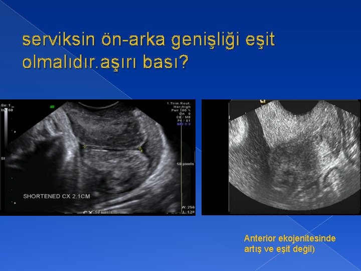 serviksin ön-arka genişliği eşit olmalıdır. aşırı bası? Anterior ekojenitesinde artış ve eşit değil) 