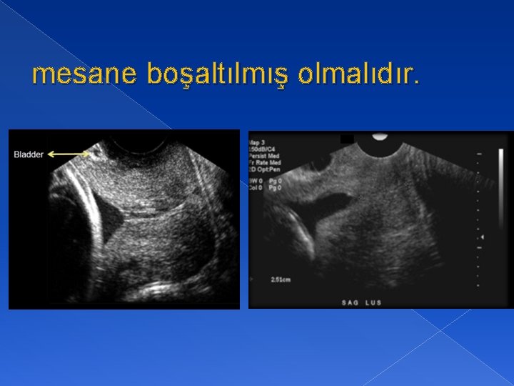 mesane boşaltılmış olmalıdır. 