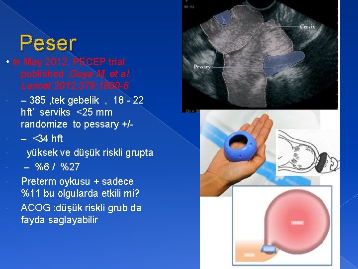 Peser • In May 2012, PECEP trial published , Goya M, et al. Lancet