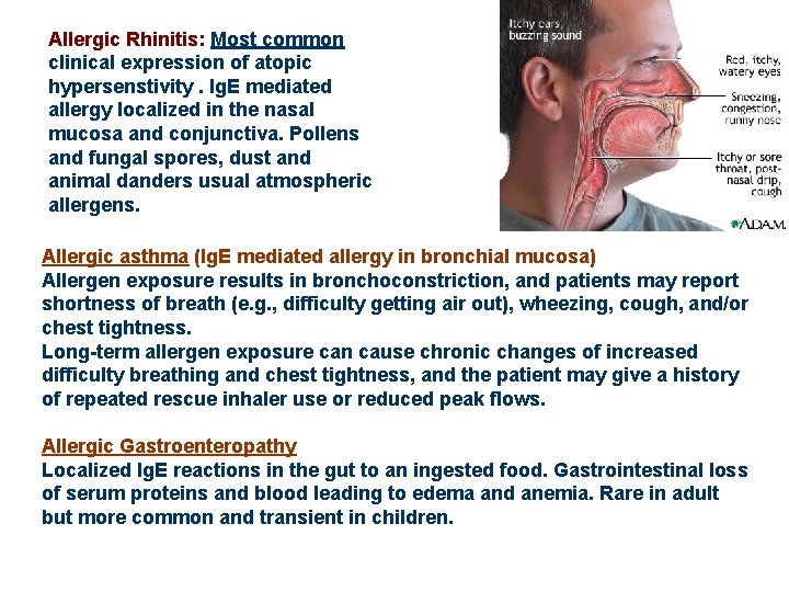 Allergic Rhinitis: Most common clinical expression of atopic hypersenstivity. Ig. E mediated allergy localized