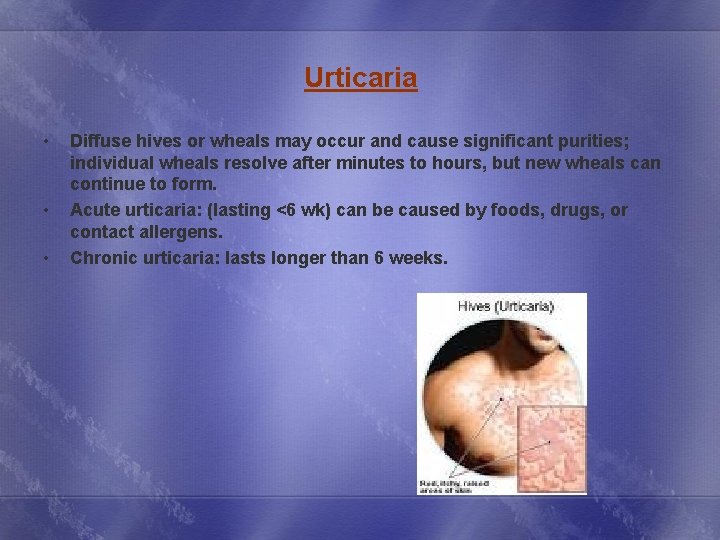 Urticaria • • • Diffuse hives or wheals may occur and cause significant purities;