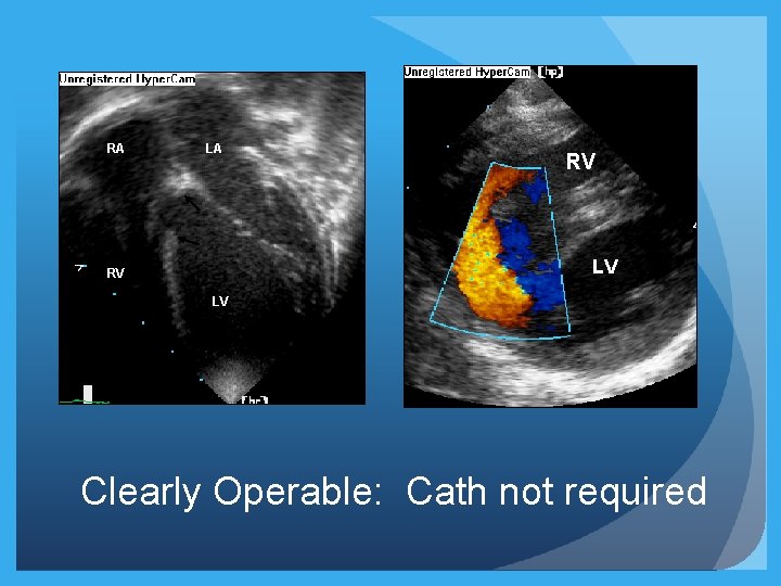 RA LA RV LV Clearly Operable: Cath not required 