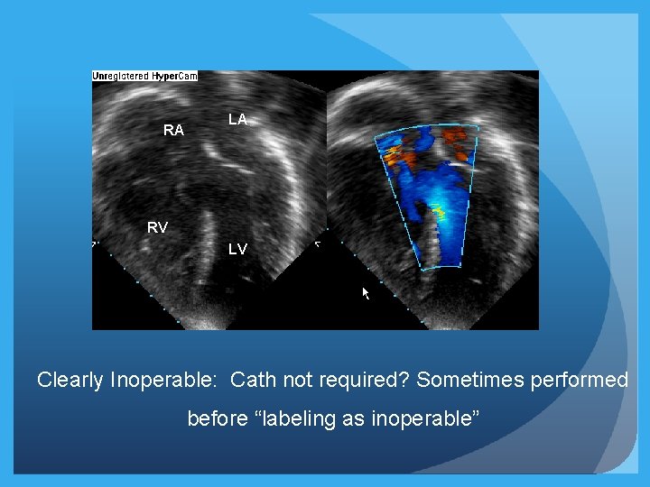 RA LA RV LV Clearly Inoperable: Cath not required? Sometimes performed before “labeling as