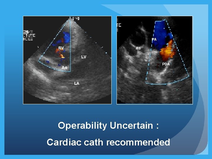 PA RV Ao LV PDA Ao LA Operability Uncertain : Cardiac cath recommended PA RV Ao LV PDA Ao LA Operability Uncertain : Cardiac cath recommended