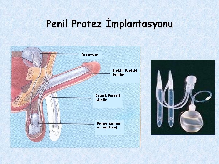 Penil Protez İmplantasyonu Rezervuar Erektil Fazdaki Silindir Gevşek Fazdaki Silindir Pompa (şişirme ve boşaltma)