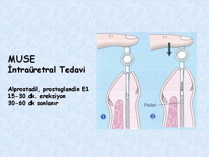 MUSE İntraüretral Tedavi Alprostadil, prostoglandin E 1 15 -30 dk. ereksiyon 30 -60 dk