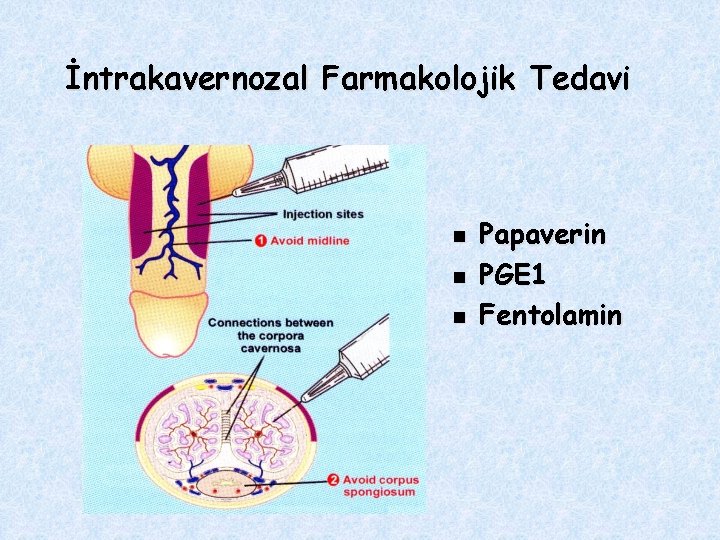 İntrakavernozal Farmakolojik Tedavi n n n Papaverin PGE 1 Fentolamin 