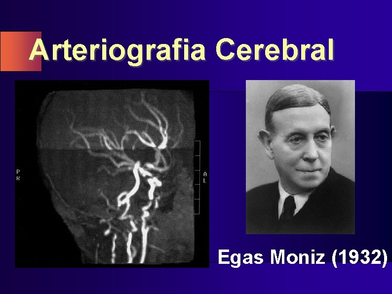 Arteriografia Cerebral Egas Moniz (1932) 