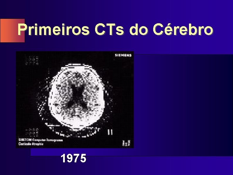 Primeiros CTs do Cérebro 1975 
