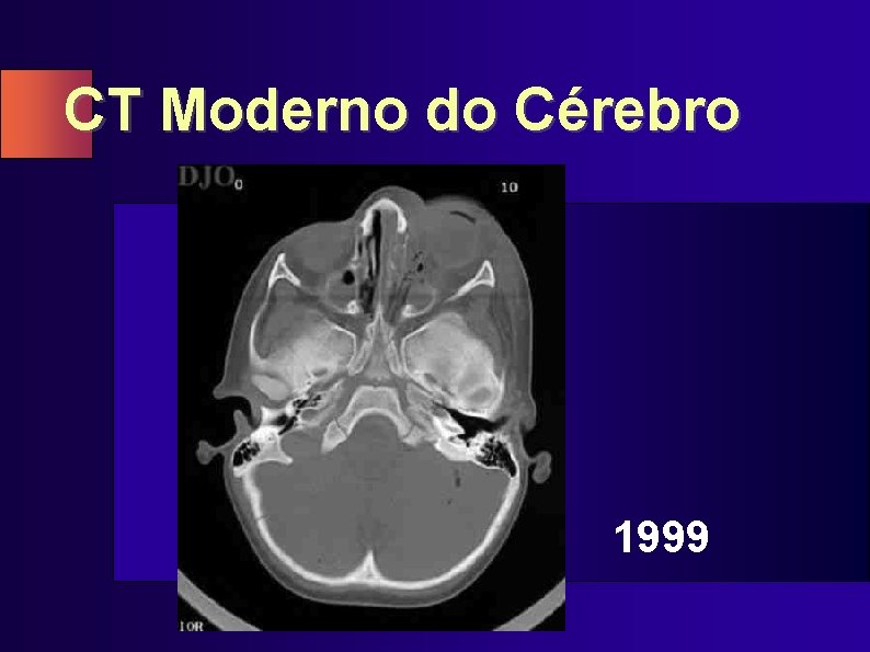 CT Moderno do Cérebro 1999 