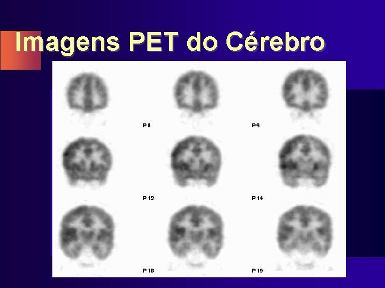 Imagens PET do Cérebro 