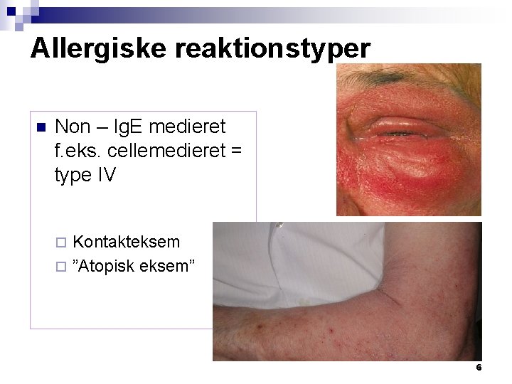 Allergiske reaktionstyper n Non – Ig. E medieret f. eks. cellemedieret = type IV