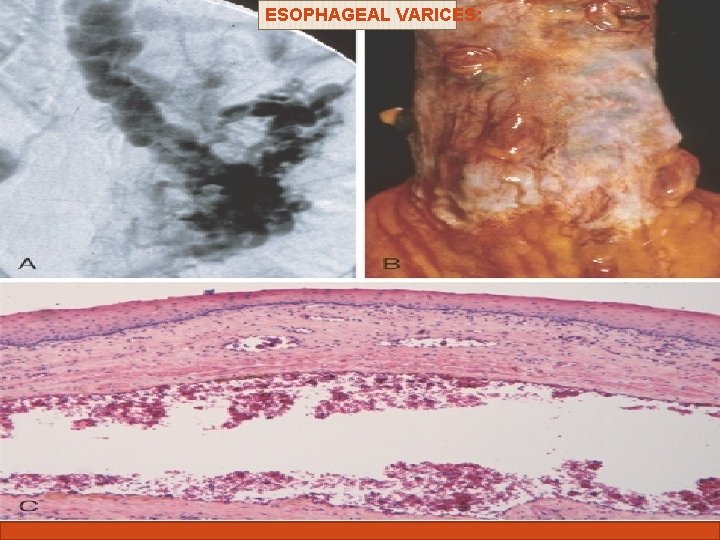 ESOPHAGEAL VARICES: Complications of liver cirrhosis 