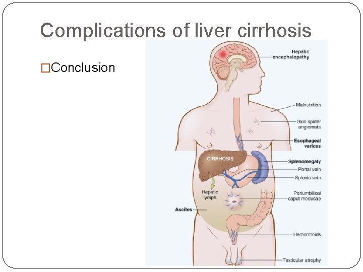 Complications of liver cirrhosis �Conclusion 