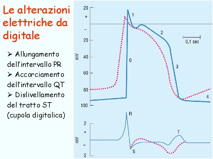 Le alterazioni elettriche da digitale Ø Allungamento dell’intervallo PR Ø Accorciamento dell’intervallo QT Ø