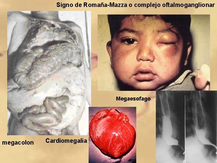 Signo de Romaña-Mazza o complejo oftalmoganglionar Megaesofago megacolon Cardiomegalia 