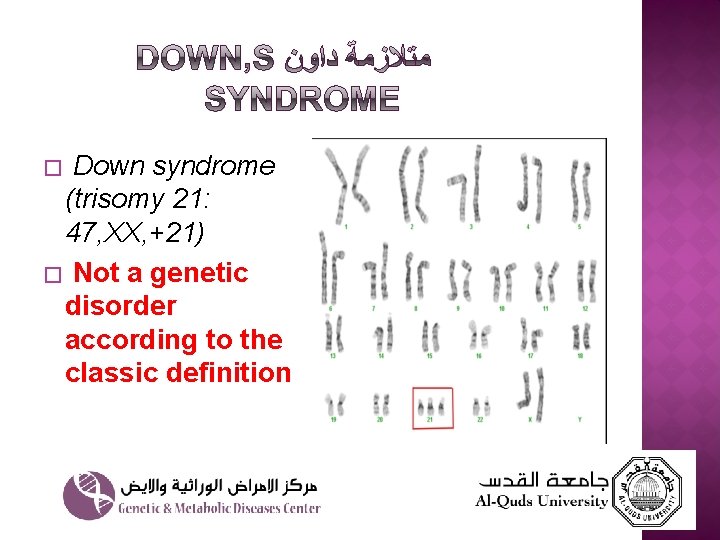 � Down syndrome (trisomy 21: 47, XX, +21) � Not a genetic disorder according