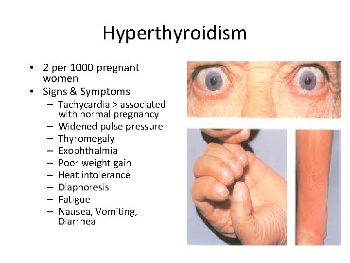 Hyperthyroidism • 2 per 1000 pregnant women • Signs & Symptoms – Tachycardia >