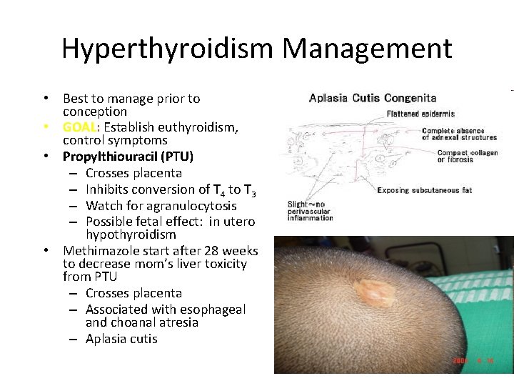 Hyperthyroidism Management • Best to manage prior to conception • GOAL: Establish euthyroidism, control