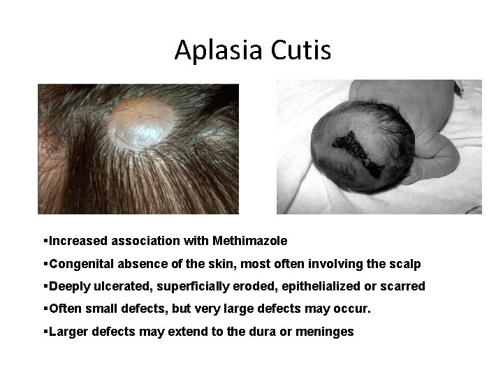 Aplasia Cutis §Increased association with Methimazole §Congenital absence of the skin, most often involving