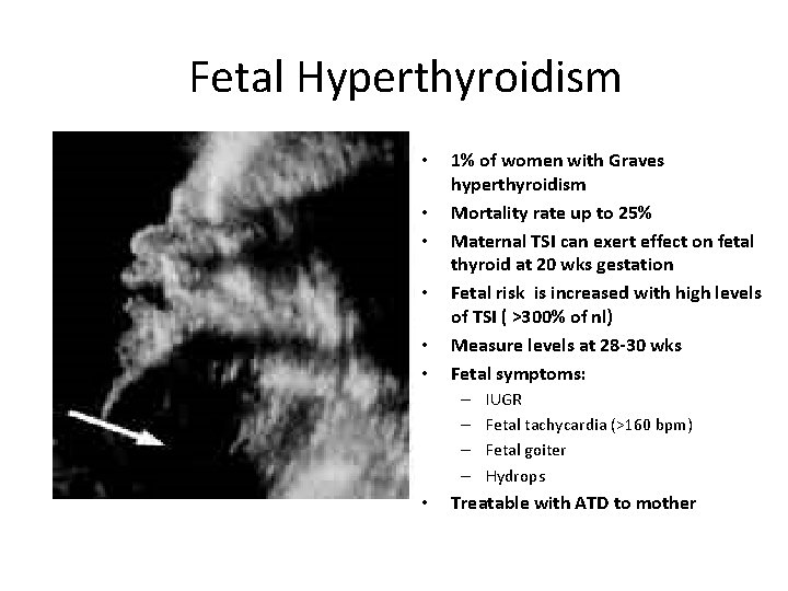 Fetal Hyperthyroidism • • • 1% of women with Graves hyperthyroidism Mortality rate up