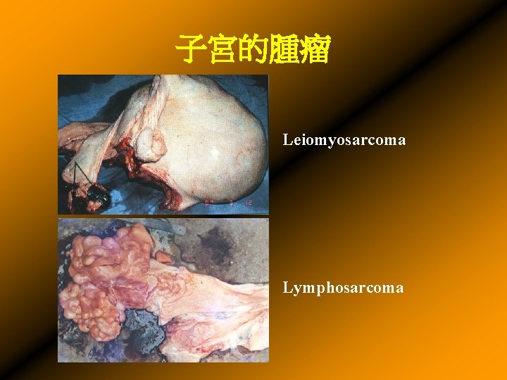 子宮的腫瘤 Leiomyosarcoma Lymphosarcoma 