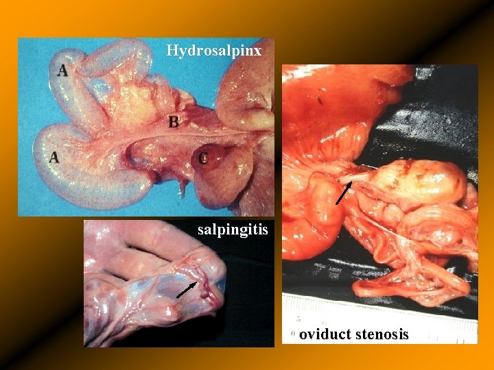 Hydrosalpinx salpingitis oviduct stenosis 