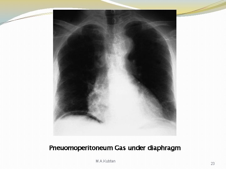 Pneuomoperitoneum Gas under diaphragm M. A. Kubtan 23 Pneuomoperitoneum Gas under diaphragm M. A. Kubtan 23