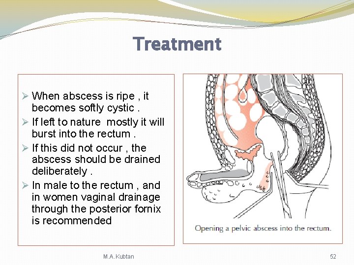 Treatment Ø When abscess is ripe , it becomes softly cystic. Ø If left Treatment Ø When abscess is ripe , it becomes softly cystic. Ø If left
