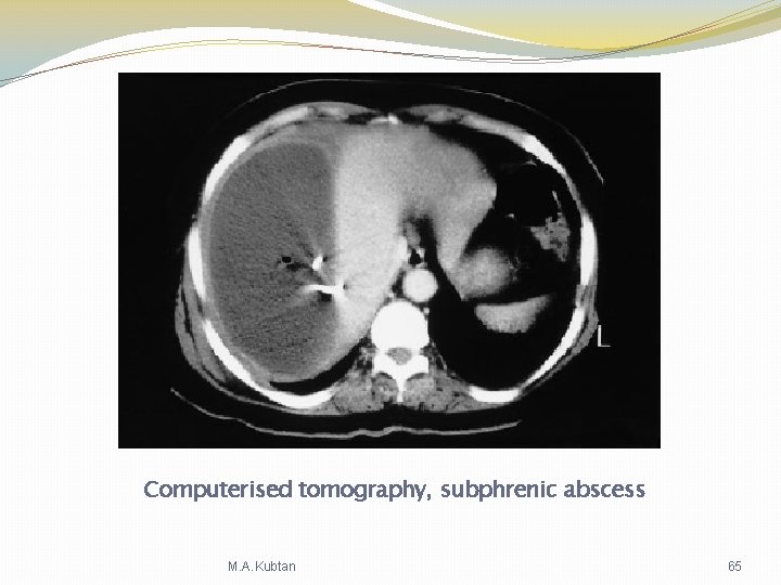 Computerised tomography, subphrenic abscess M. A. Kubtan 65 Computerised tomography, subphrenic abscess M. A. Kubtan 65