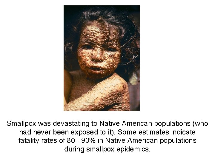Smallpox was devastating to Native American populations (who had never been exposed to it). Smallpox was devastating to Native American populations (who had never been exposed to it).