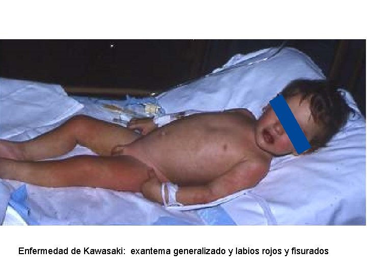 Enfermedad de Kawasaki: exantema generalizado y labios rojos y fisurados Enfermedad de Kawasaki: exantema generalizado y labios rojos y fisurados