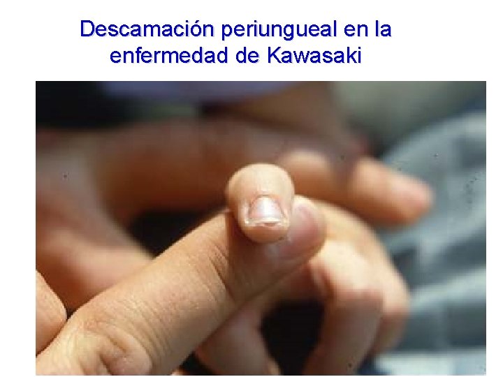 Descamación periungueal en la enfermedad de Kawasaki Descamación periungueal en la enfermedad de Kawasaki