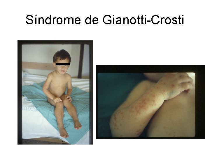Síndrome de Gianotti-Crosti Síndrome de Gianotti-Crosti