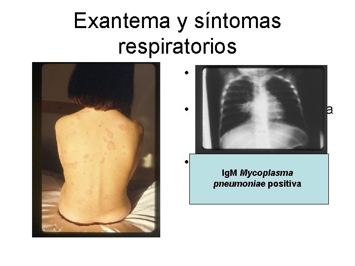 Exantema y síntomas respiratorios • Niña de 10 años de edad • Tos y Exantema y síntomas respiratorios • Niña de 10 años de edad • Tos y