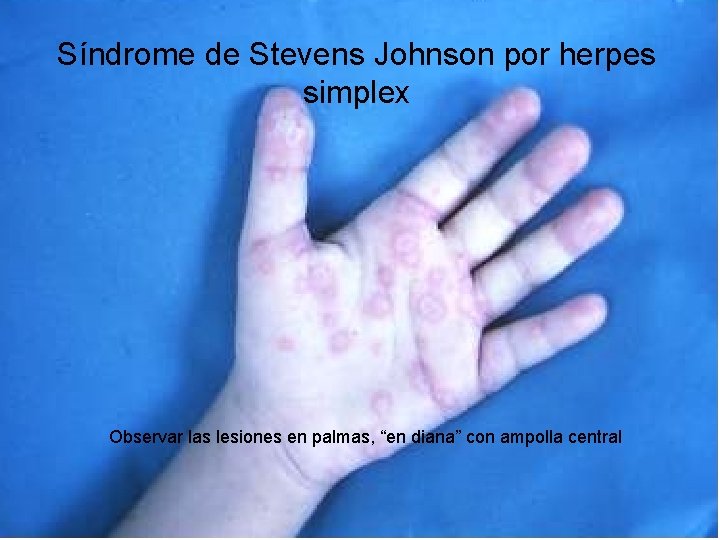 Síndrome de Stevens Johnson por herpes simplex Observar las lesiones en palmas, “en diana” Síndrome de Stevens Johnson por herpes simplex Observar las lesiones en palmas, “en diana”
