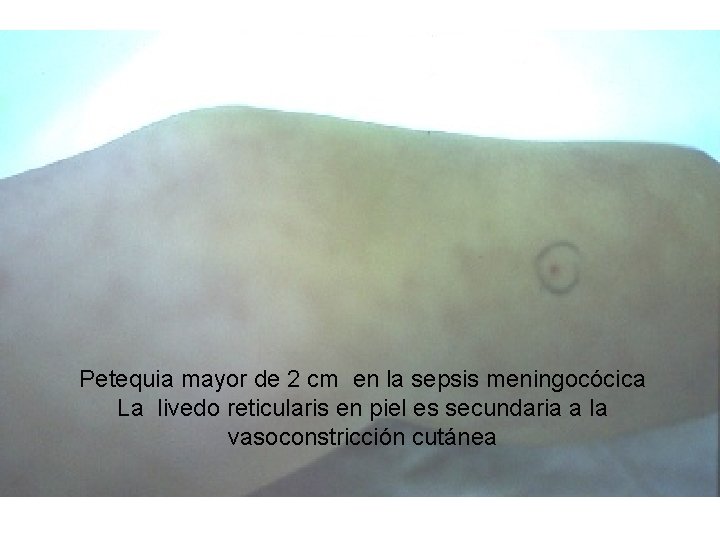 Petequia mayor de 2 cm en la sepsis meningocócica La livedo reticularis en piel Petequia mayor de 2 cm en la sepsis meningocócica La livedo reticularis en piel