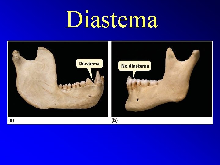 Diastema 