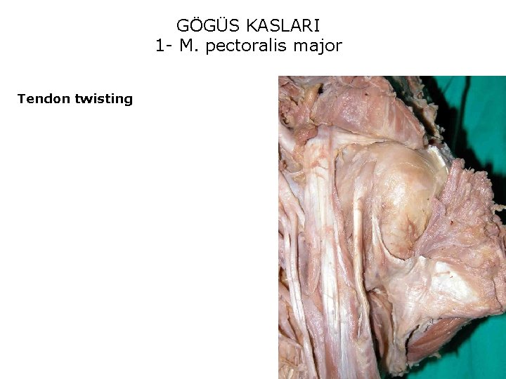 GÖGÜS KASLARI 1 - M. pectoralis major Tendon twisting 